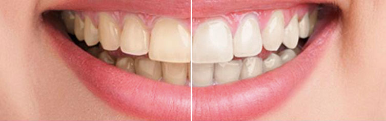 Quickly Whiten Teeth In Adobe Photoshop